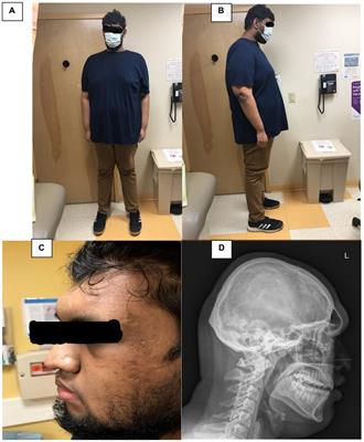 Novel duplication of the cell adhesion molecule L1-like gene in an individual with cognitive impairment, tall stature, and obesity: A case report